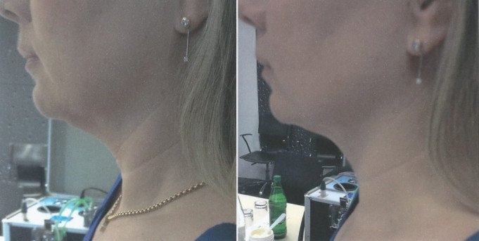 Gelaatsbehandeling Ekeren, Antwerpen